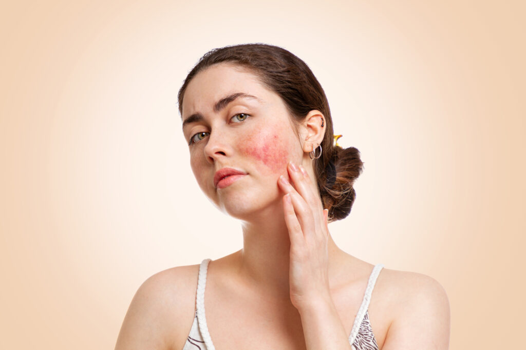 Portrait of a young pretty Caucasian woman who frowns and shows reddened and inflamed cheeks. Beige background. Copy space. The concept of rosacea, healthcare and couperose.